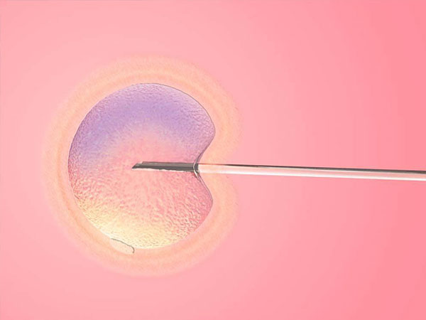 排卵性不孕的头号病症-多囊性卵巢症候群